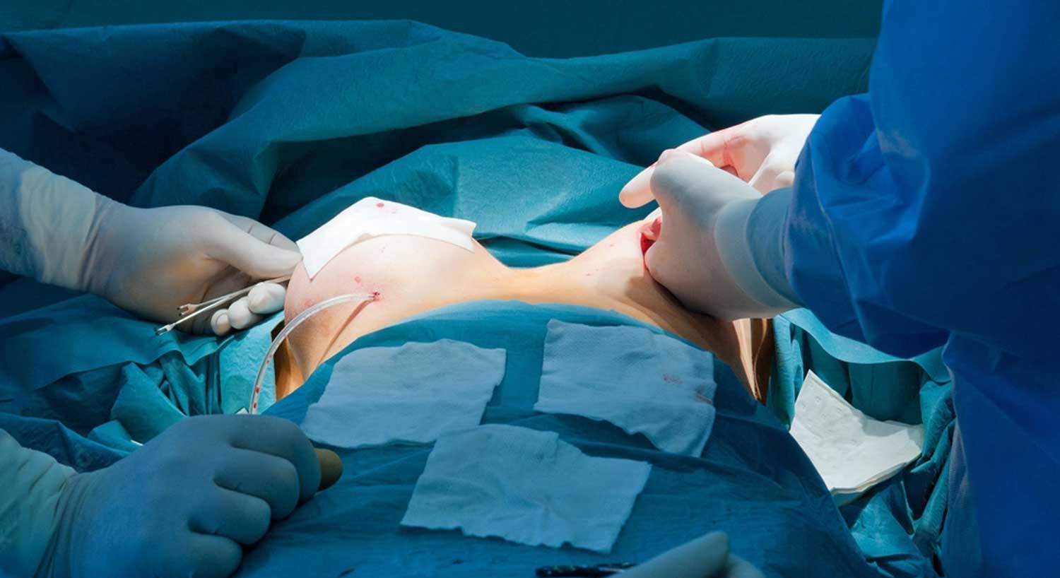 Breast Surgery
