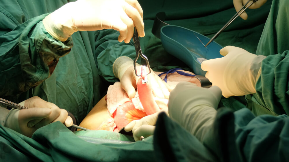 Colorectal Surgery