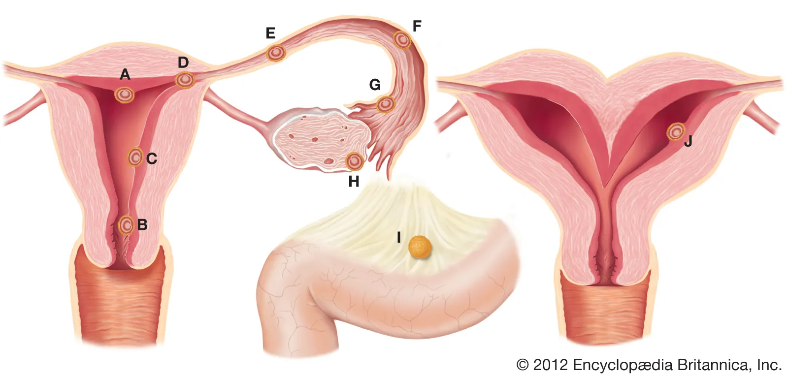 Ectopic Pregnancy
