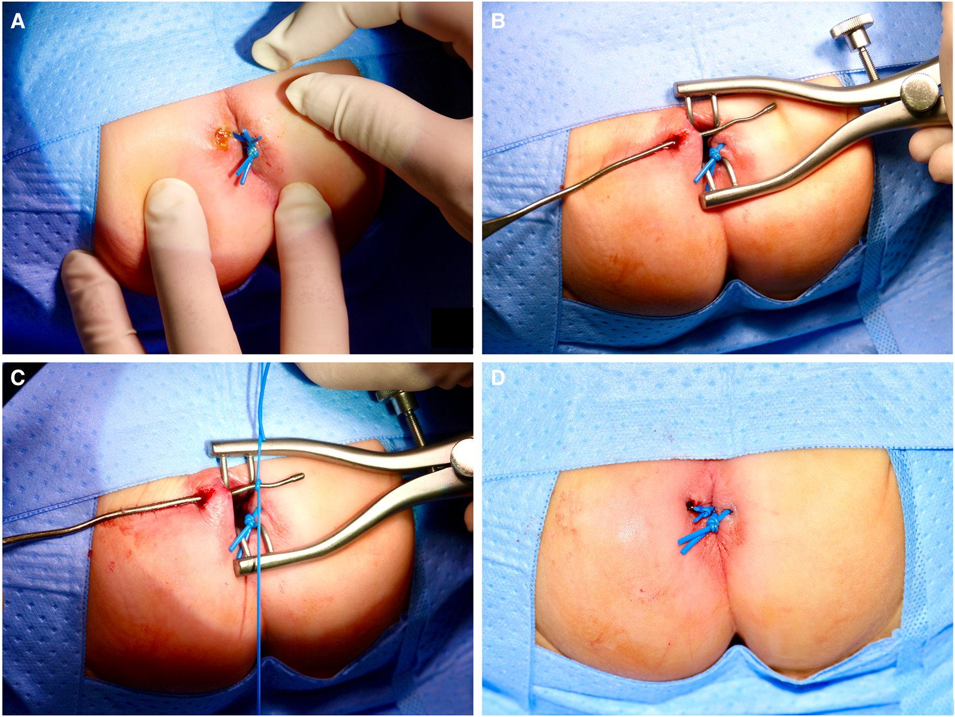 Fissure-in-Ano