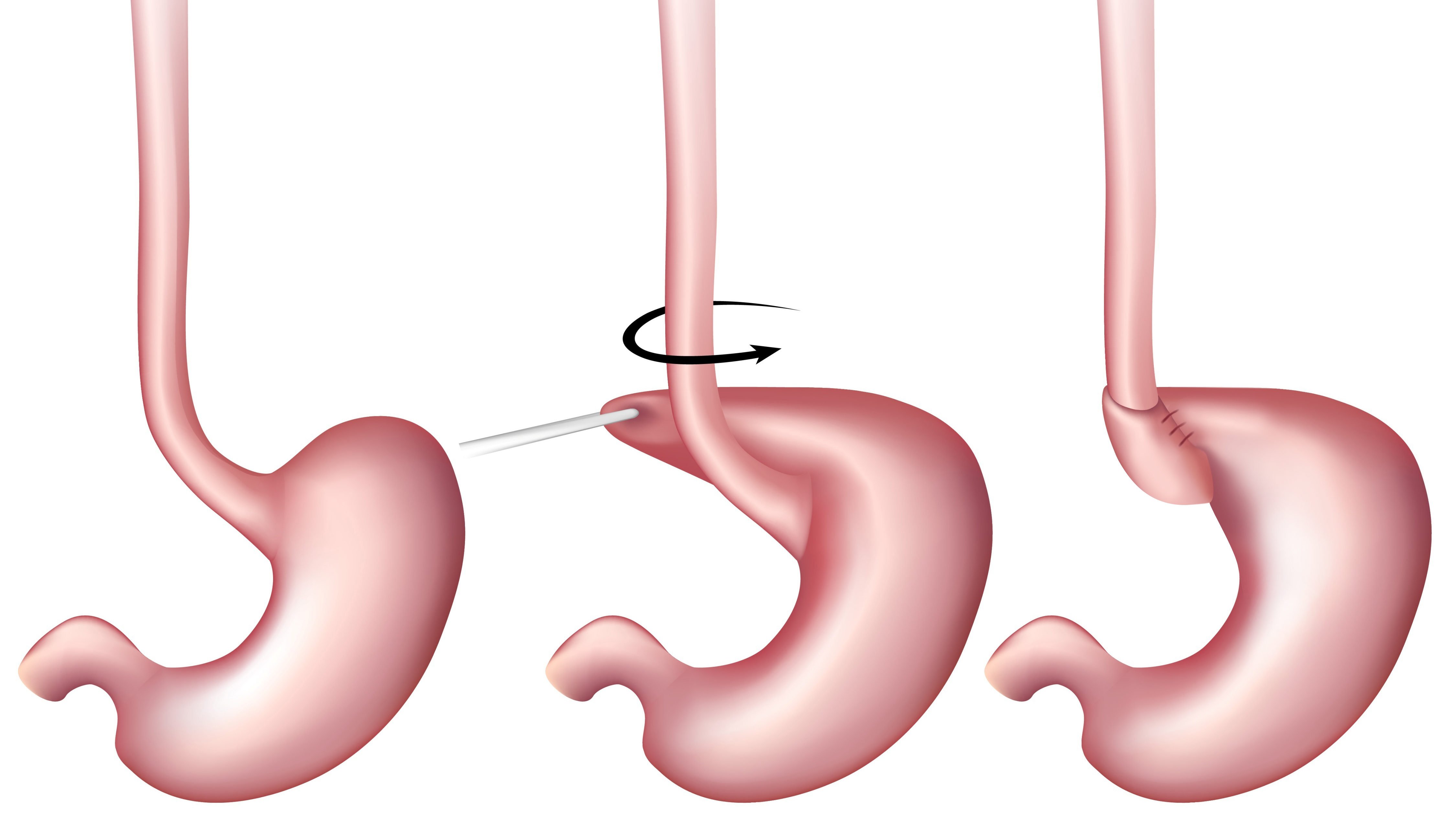 GERD Surgery