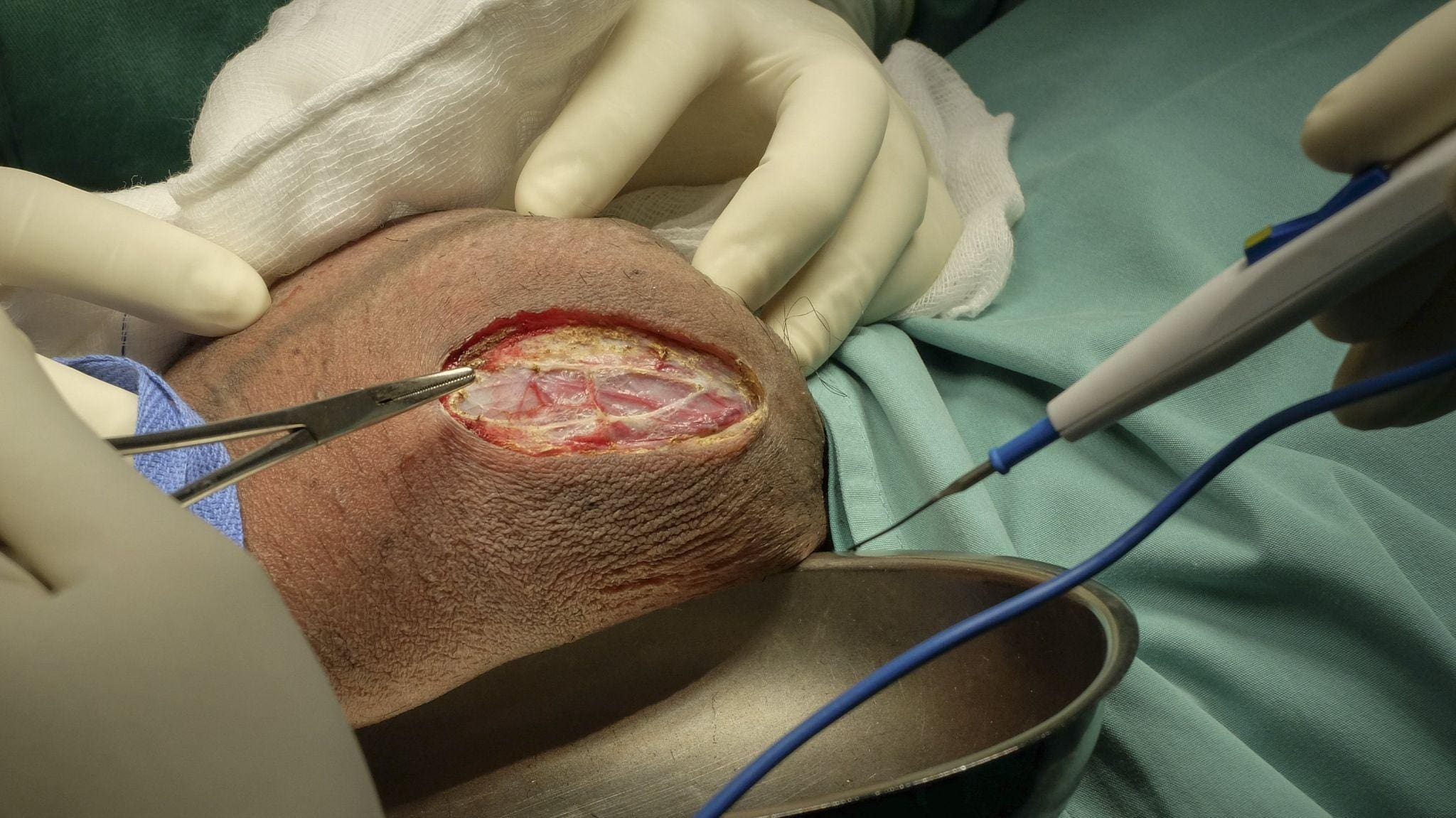 Hydrocele Surgery