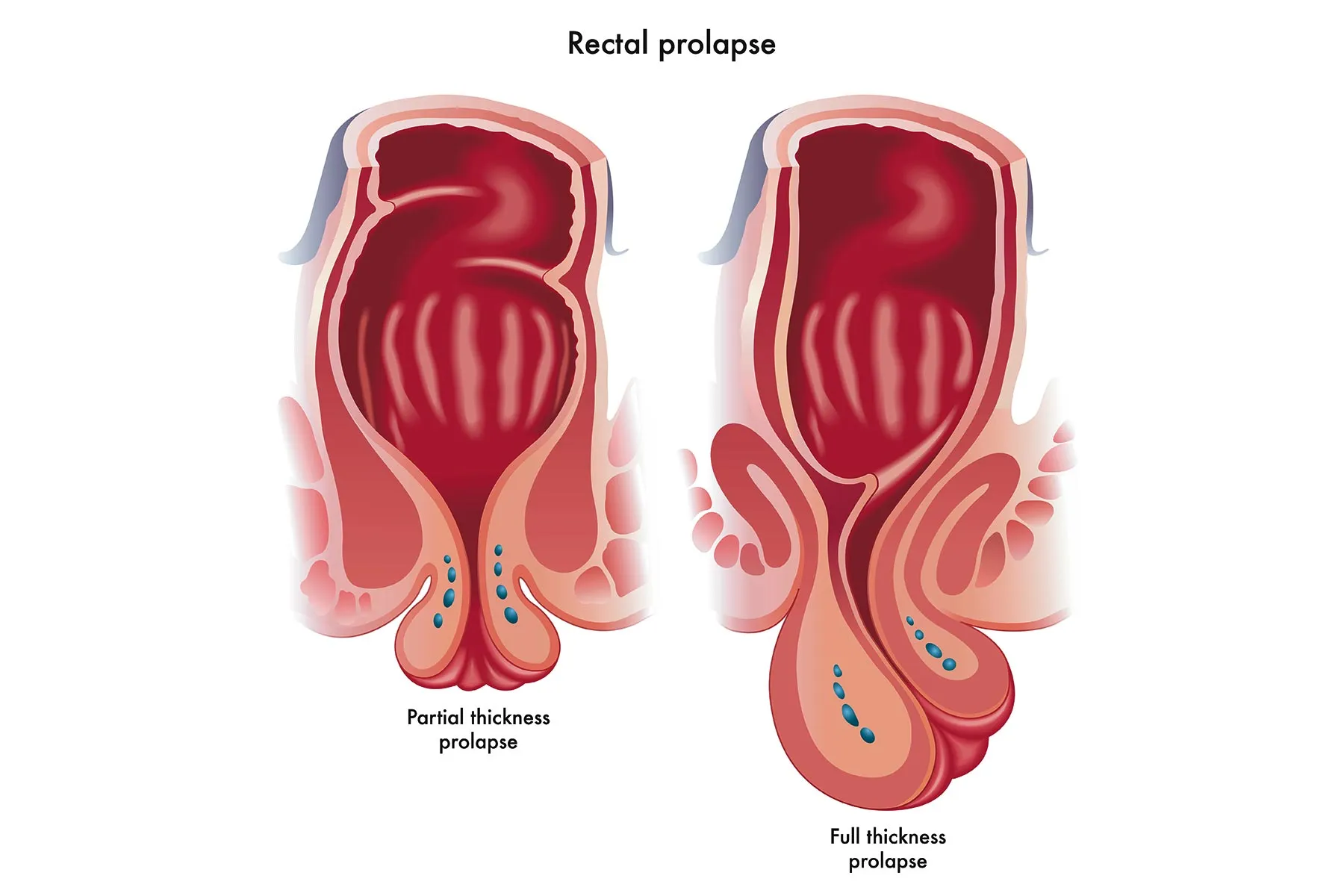 Rectal Prolapse