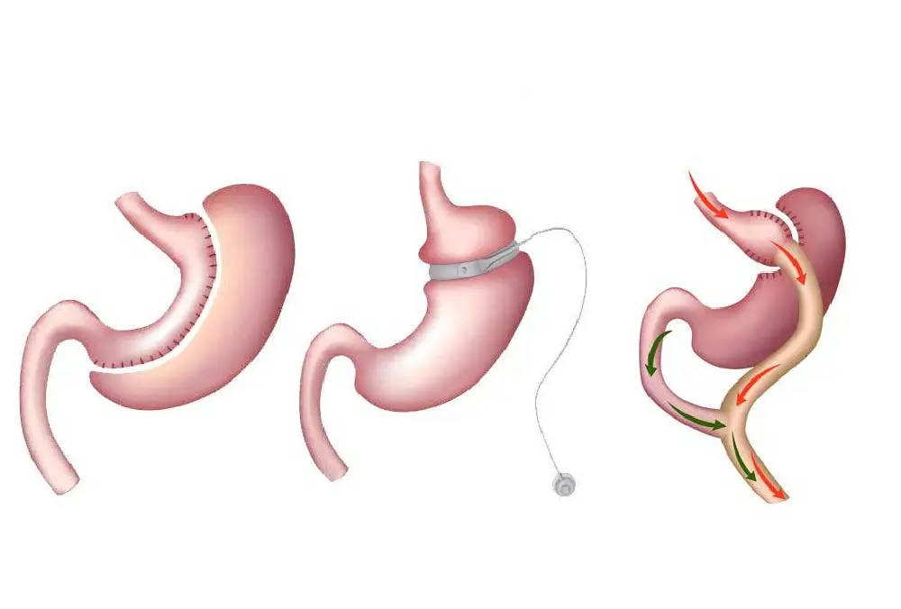 Revision Bariatric