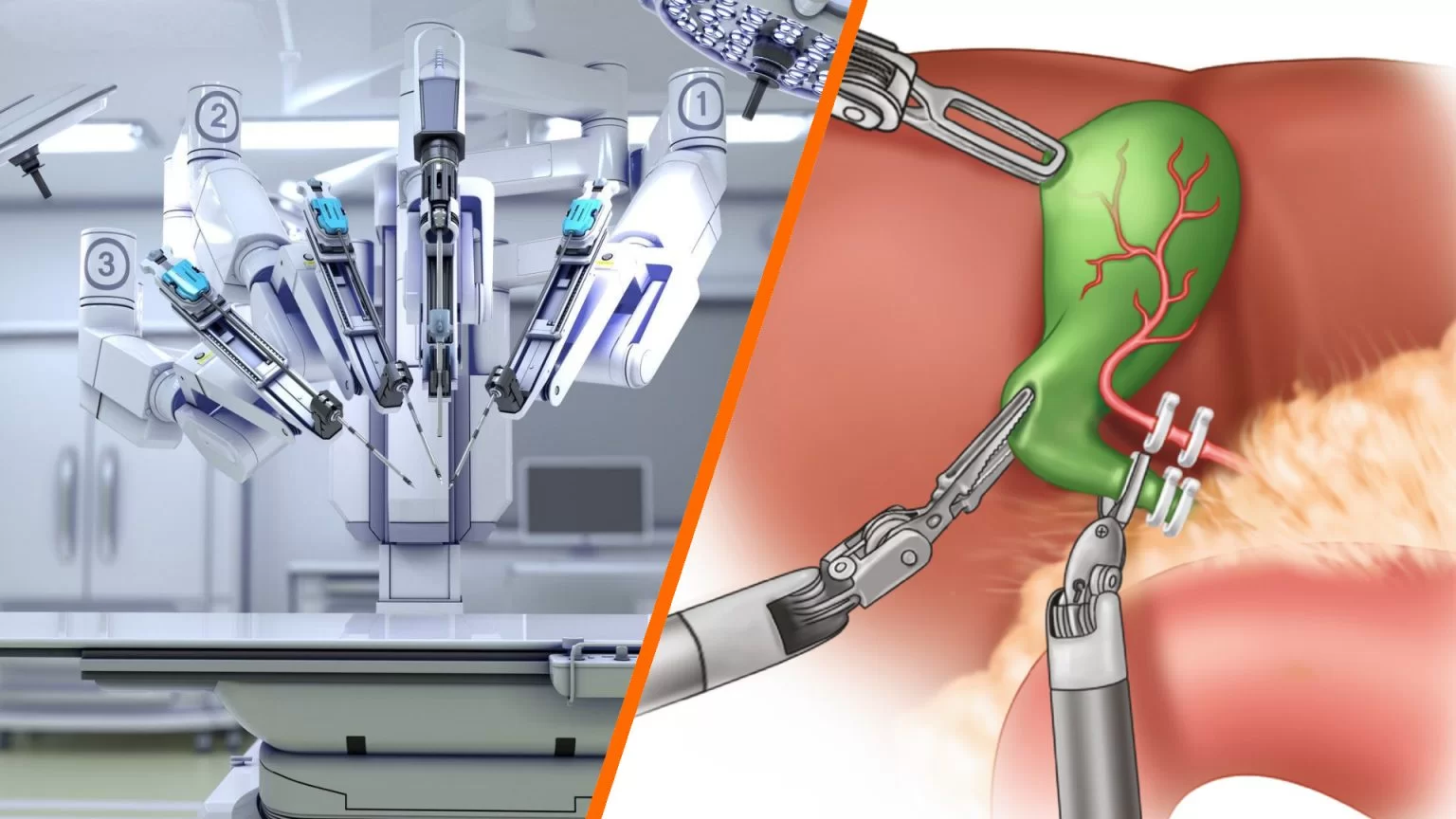 Robotic Gallstone Surgery