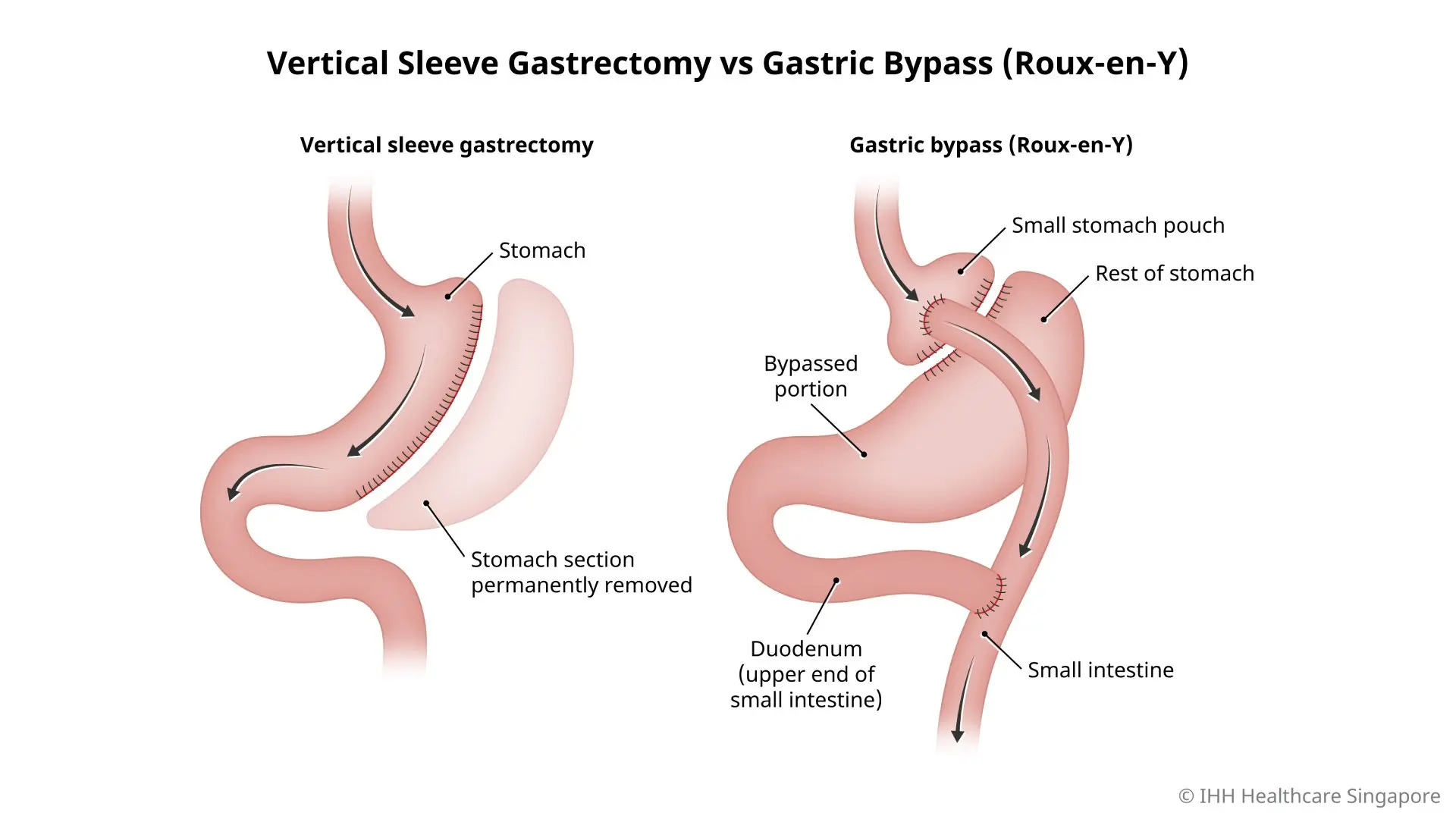 Sleeve Gastrectomy