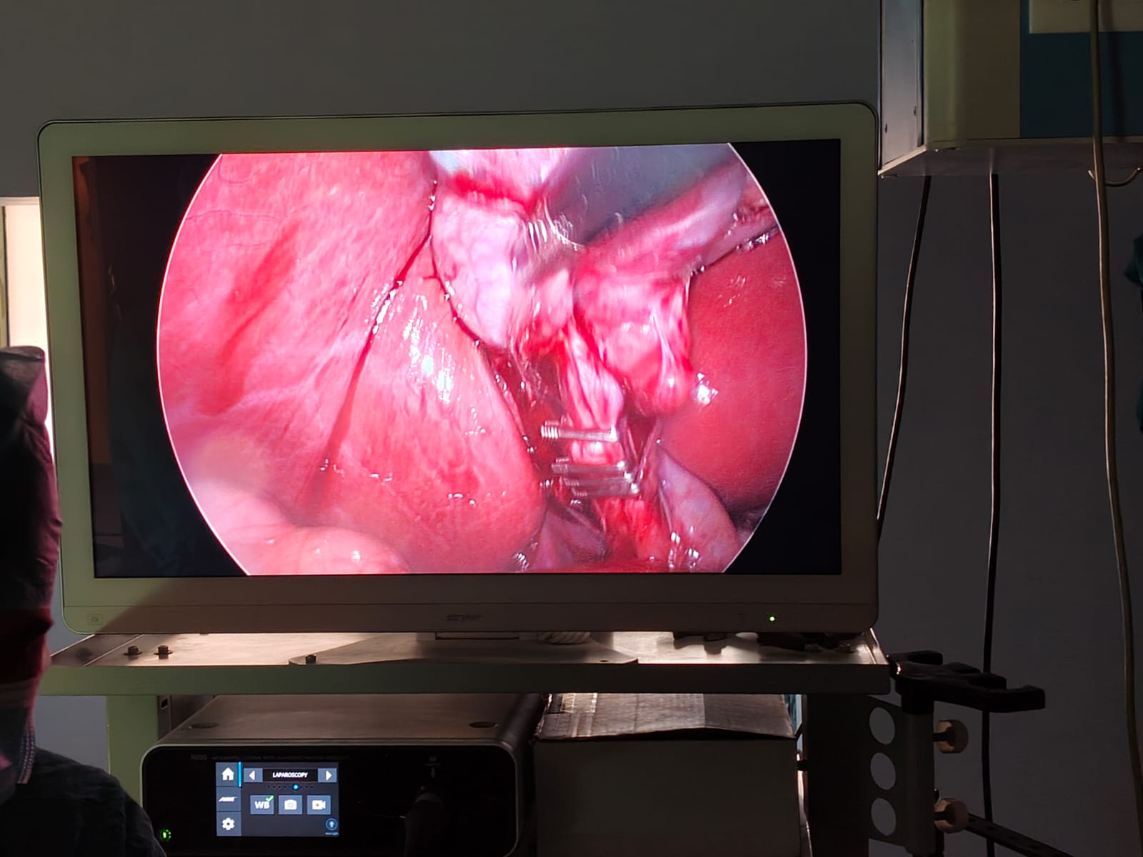 Basic Laparoscopic Surgery